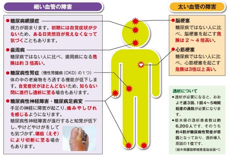 糖尿病合併症